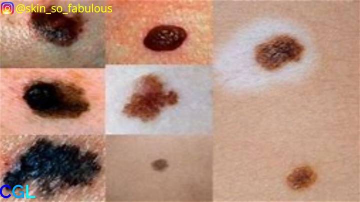 Remove a Mole and Skin Tags Yourself